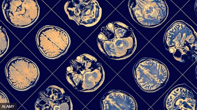 Os efeitos de longo prazo de uma pandemia sobre o&nbsp;cérebro